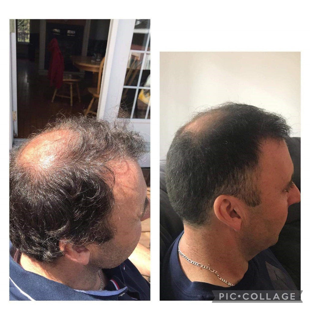 PROMO TRIO - Progressive hair loss - 3 month cure - René Furterer - 53 Karat